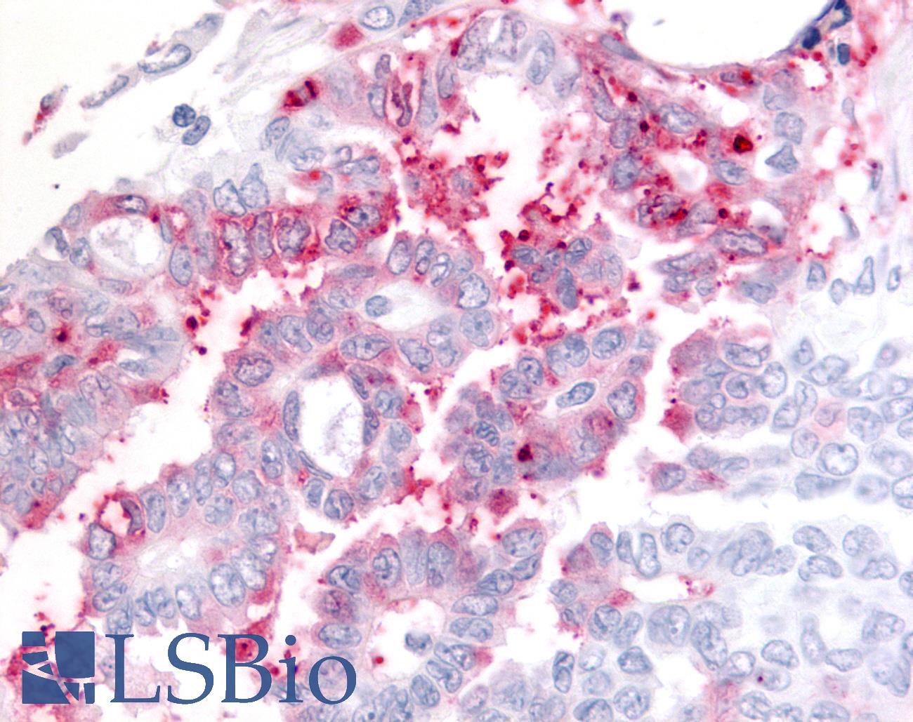 ADAMTS5 Antibody - Ovary, carcinoma