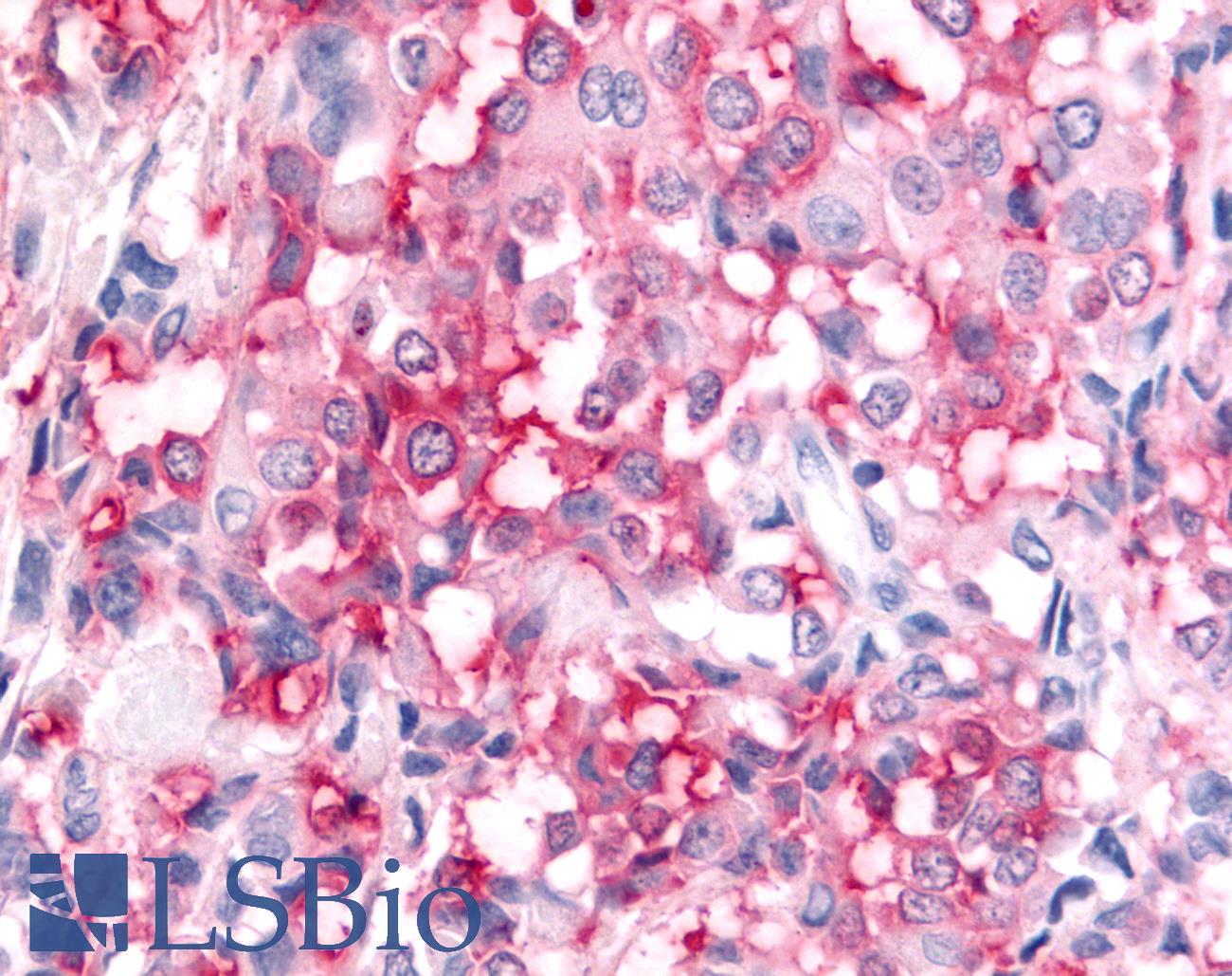 ADAMTS5 Antibody - Breast, Carcinoma