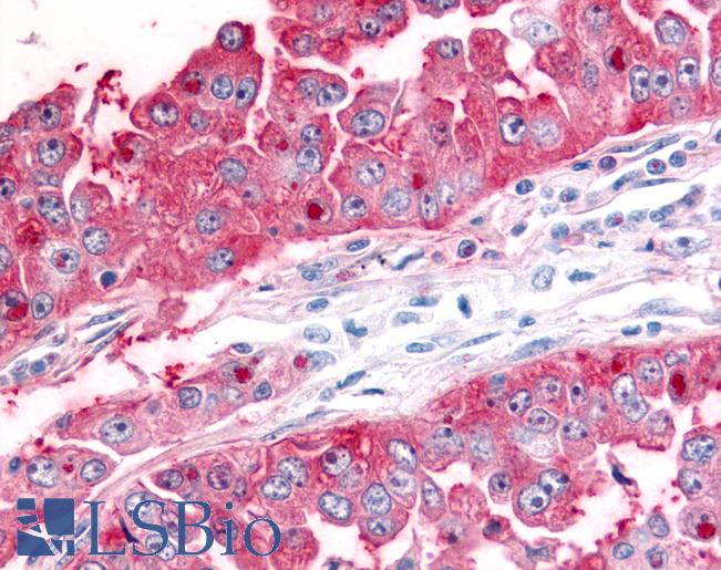 ADAMTS5 Antibody - Lung, Non Small-Cell Carcinoma