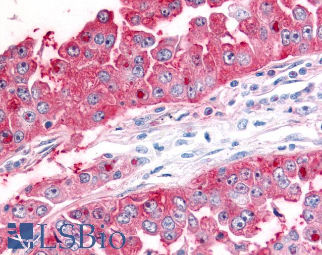 ADAMTS5 Antibody - Lung, non small cell carcinoma