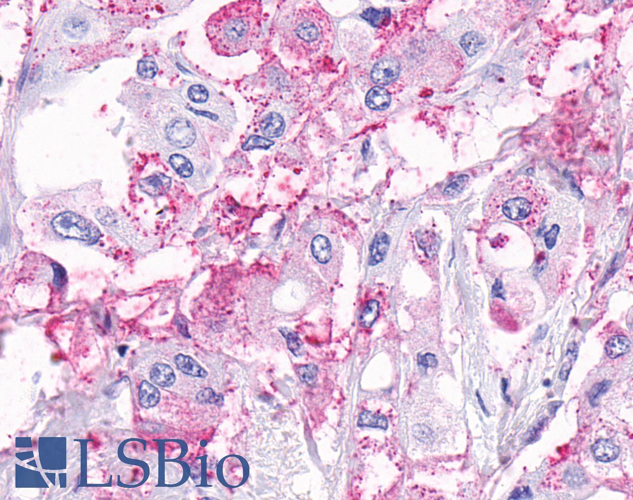 ADGRA2 / GPR124 Antibody - Breast, carcinoma
