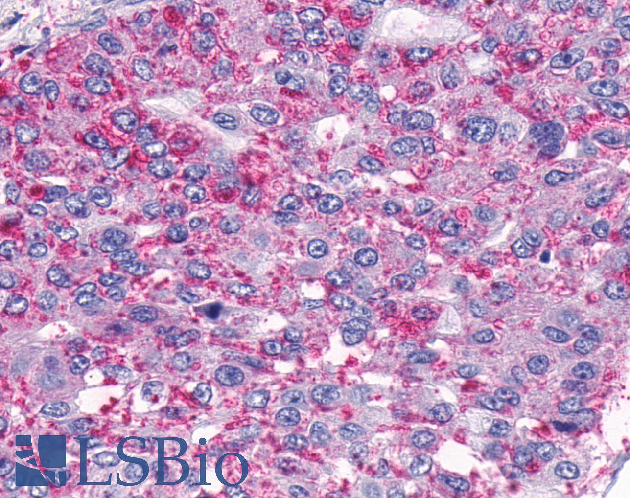 ADGRA2 / GPR124 Antibody - Lung, Non Small-Cell Carcinoma
