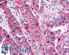 ADGRB2 / BAI2 Antibody - Anti-BAI2 antibody IHC of human Lung, Non-Small Cell Carcinoma. Immunohistochemistry of formalin-fixed, paraffin-embedded tissue after heat-induced antigen retrieval.