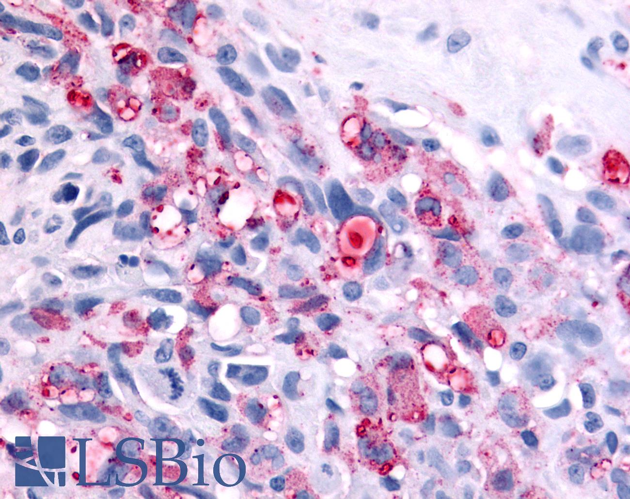 ADGRB2 / BAI2 Antibody - Anti-BAI2 antibody IHC of human Brain, Glioblastoma. Immunohistochemistry of formalin-fixed, paraffin-embedded tissue after heat-induced antigen retrieval.