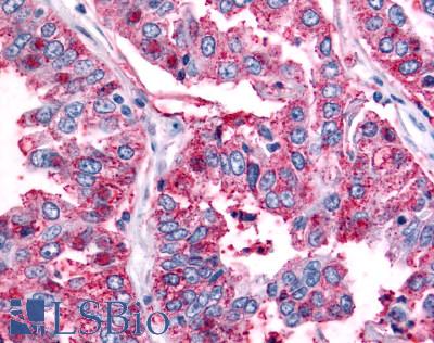 ADGRB2 / BAI2 Antibody - Lung, non small cell carcinoma