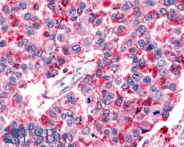 ADGRB2 / BAI2 Antibody - Anti-BAI2 antibody IHC of human Lung, Non-Small Cell Carcinoma. Immunohistochemistry of formalin-fixed, paraffin-embedded tissue after heat-induced antigen retrieval.