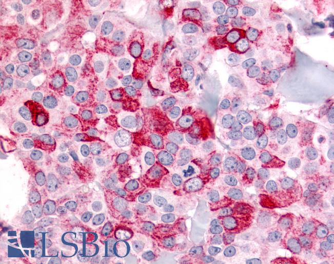 ADGRB2 / BAI2 Antibody - Anti-BAI2 antibody IHC of human Breast, Carcinoma. Immunohistochemistry of formalin-fixed, paraffin-embedded tissue after heat-induced antigen retrieval.