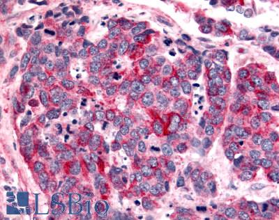 ADGRB2 / BAI2 Antibody - Lung, small cell carcinoma