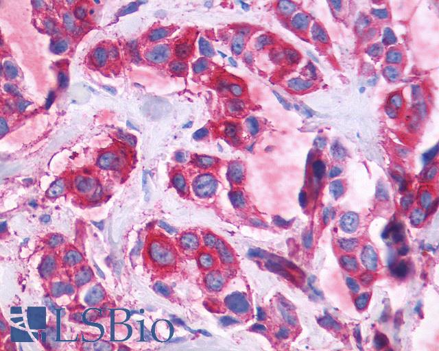 ADGRF1 / GPR110 Antibody - Anti-GPR110 antibody IHC of human Breast, Carcinoma. Immunohistochemistry of formalin-fixed, paraffin-embedded tissue after heat-induced antigen retrieval.