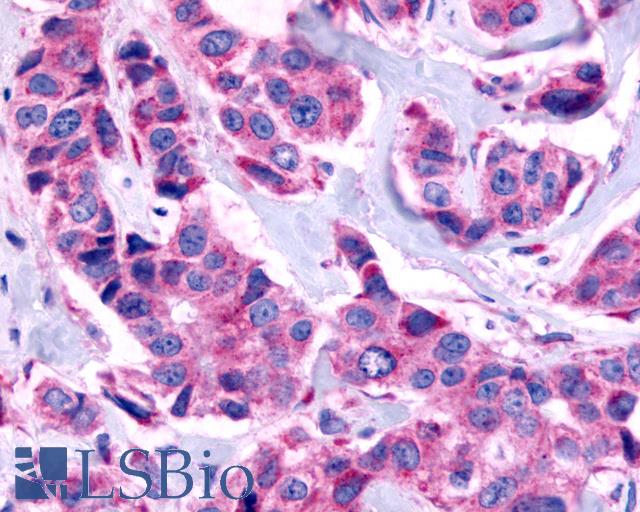 ADGRF4 / GPR115 Antibody - Anti-GPR115 antibody IHC of human Breast, Carcinoma. Immunohistochemistry of formalin-fixed, paraffin-embedded tissue after heat-induced antigen retrieval.