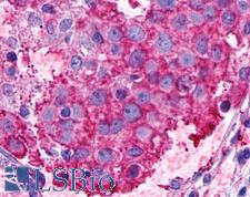 ADGRF5 / GPR116 Antibody - Anti-GPR116 antibody IHC of human Breast, Carcinoma. Immunohistochemistry of formalin-fixed, paraffin-embedded tissue after heat-induced antigen retrieval.