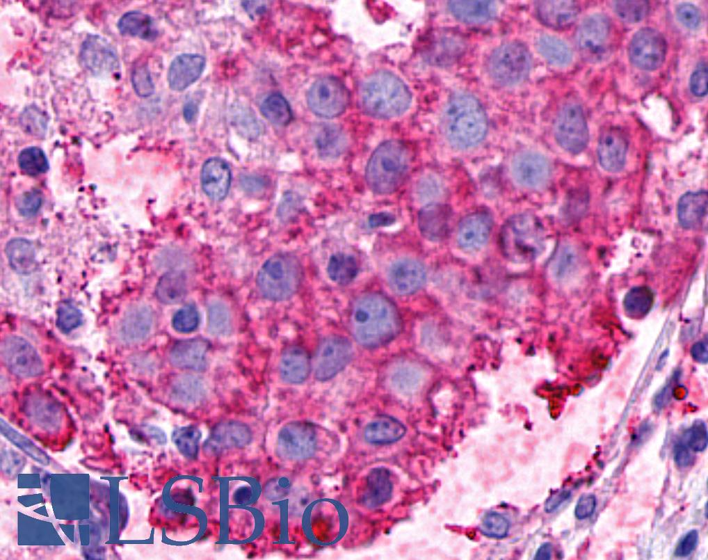 ADGRF5 / GPR116 Antibody - Anti-GPR116 antibody IHC of human Breast, Carcinoma. Immunohistochemistry of formalin-fixed, paraffin-embedded tissue after heat-induced antigen retrieval.