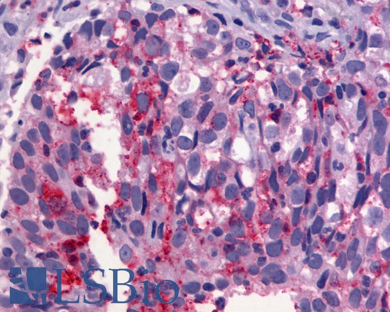 ADGRG1 / GPR56 Antibody - Lung, adenocarcinoma