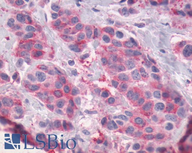ADGRG1 / GPR56 Antibody - Breast, Carcinoma