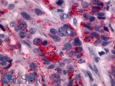 ADGRG1 / GPR56 Antibody - Breast, Carcinoma