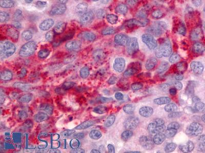 ADGRG1 / GPR56 Antibody - Ovary, carcinoma
