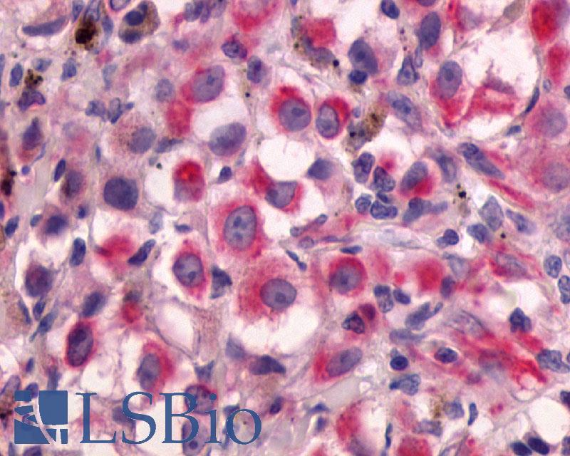 ADGRG2 / GPR64 Antibody - Skin, Malignant Melanoma