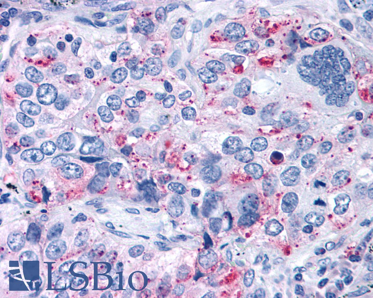 ADGRG3 / GPR97 Antibody - Lung, Non Small-Cell Carcinoma
