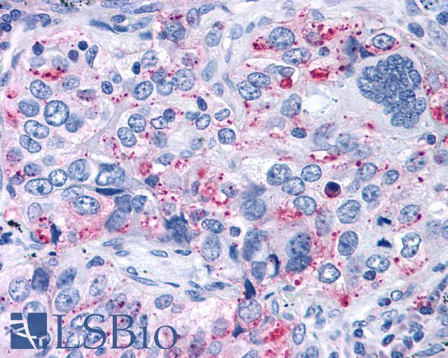 ADGRG3 / GPR97 Antibody - Lung, Non Small-Cell Carcinoma