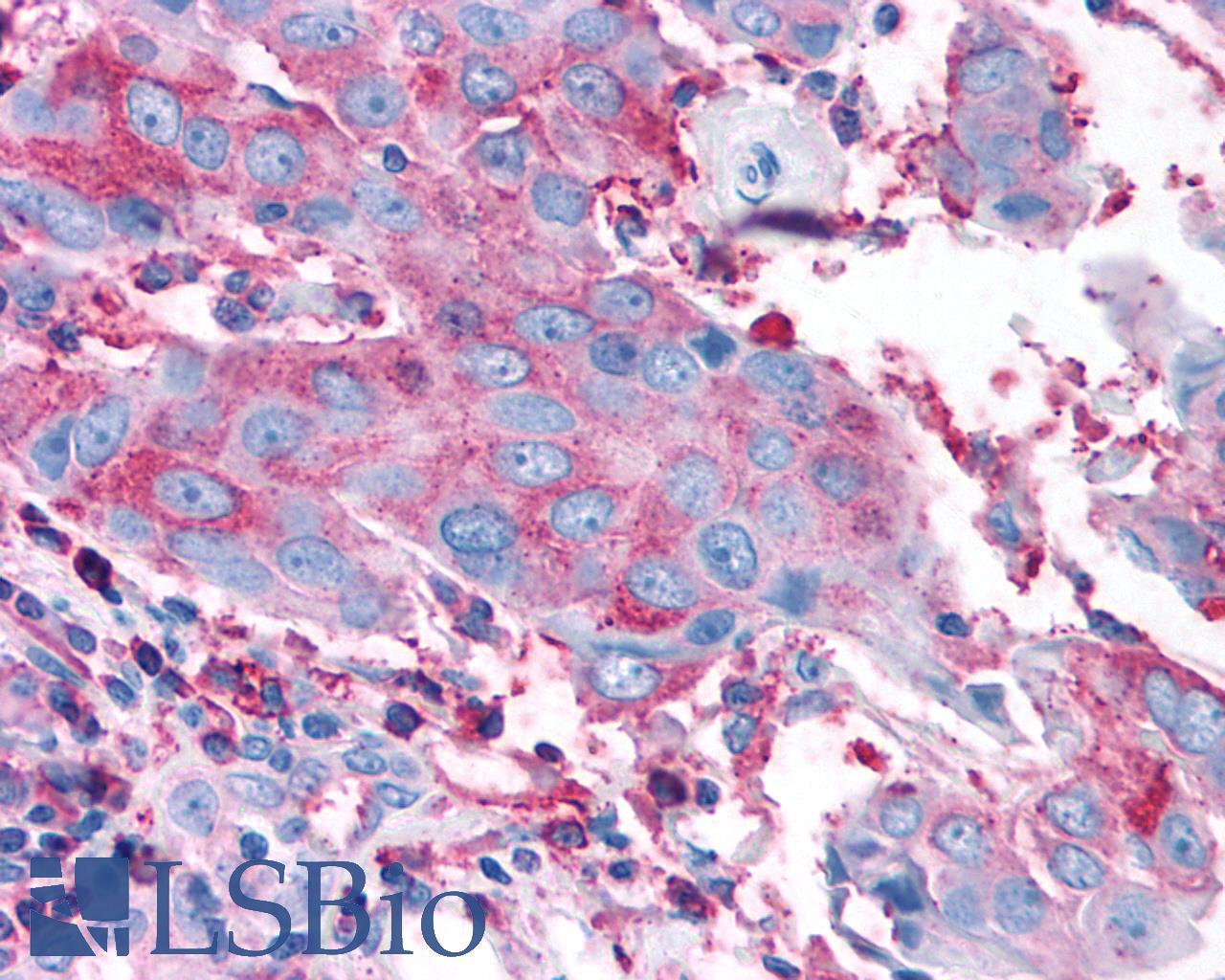 ADGRG3 / GPR97 Antibody - Breast, Carcinoma