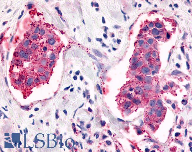 ADGRL4 / ELTD1 Antibody - Anti-ELTD1 antibody IHC of human Breast, Carcinoma. Immunohistochemistry of formalin-fixed, paraffin-embedded tissue after heat-induced antigen retrieval.