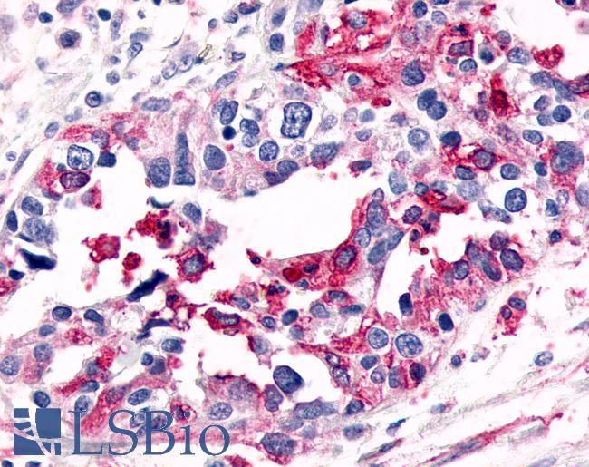 ADGRL4 / ELTD1 Antibody - Ovary, carcinoma