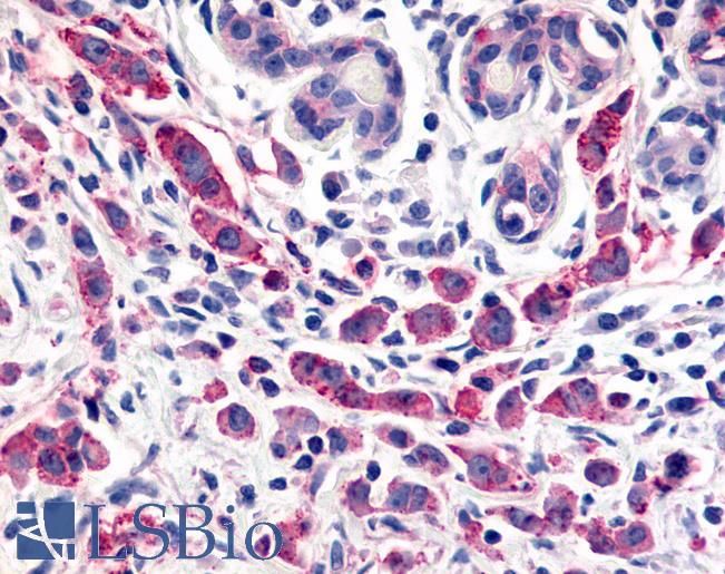ADGRL4 / ELTD1 Antibody - Anti-ELTD1 antibody IHC of human Breast, Carcinoma. Immunohistochemistry of formalin-fixed, paraffin-embedded tissue after heat-induced antigen retrieval.