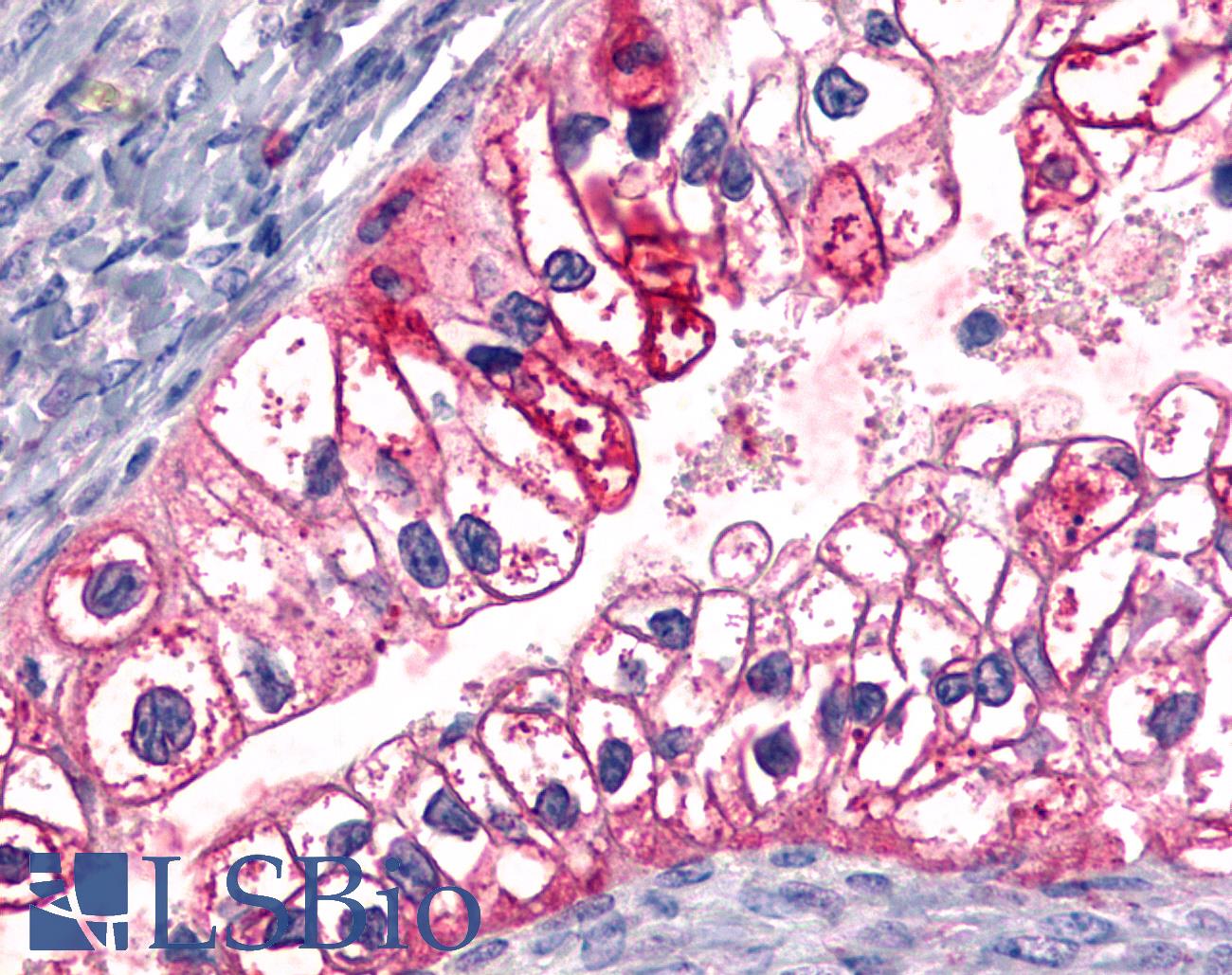ADGRL4 / ELTD1 Antibody - Ovary, Carcinoma