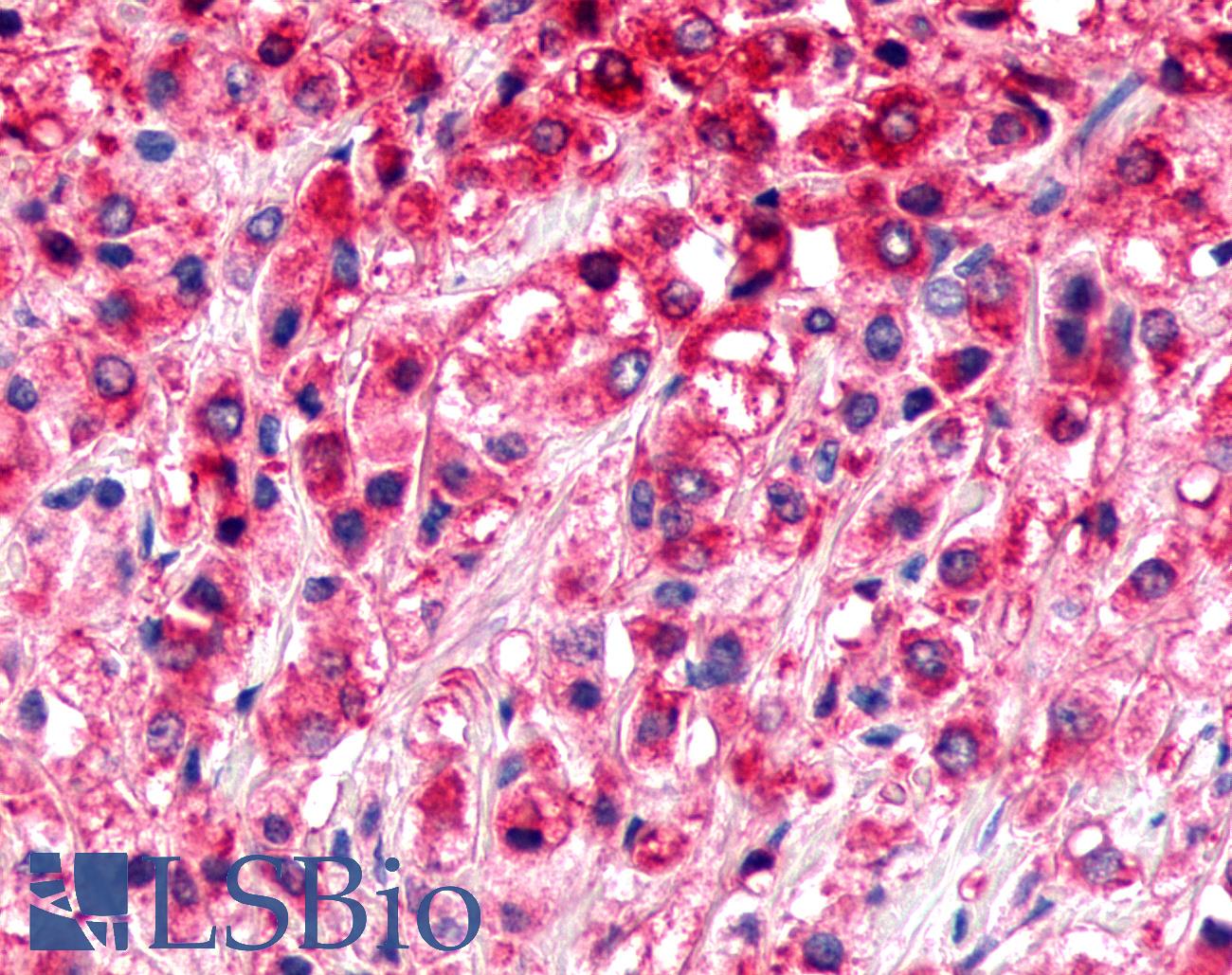 ADGRL4 / ELTD1 Antibody - Prostate, Carcinoma