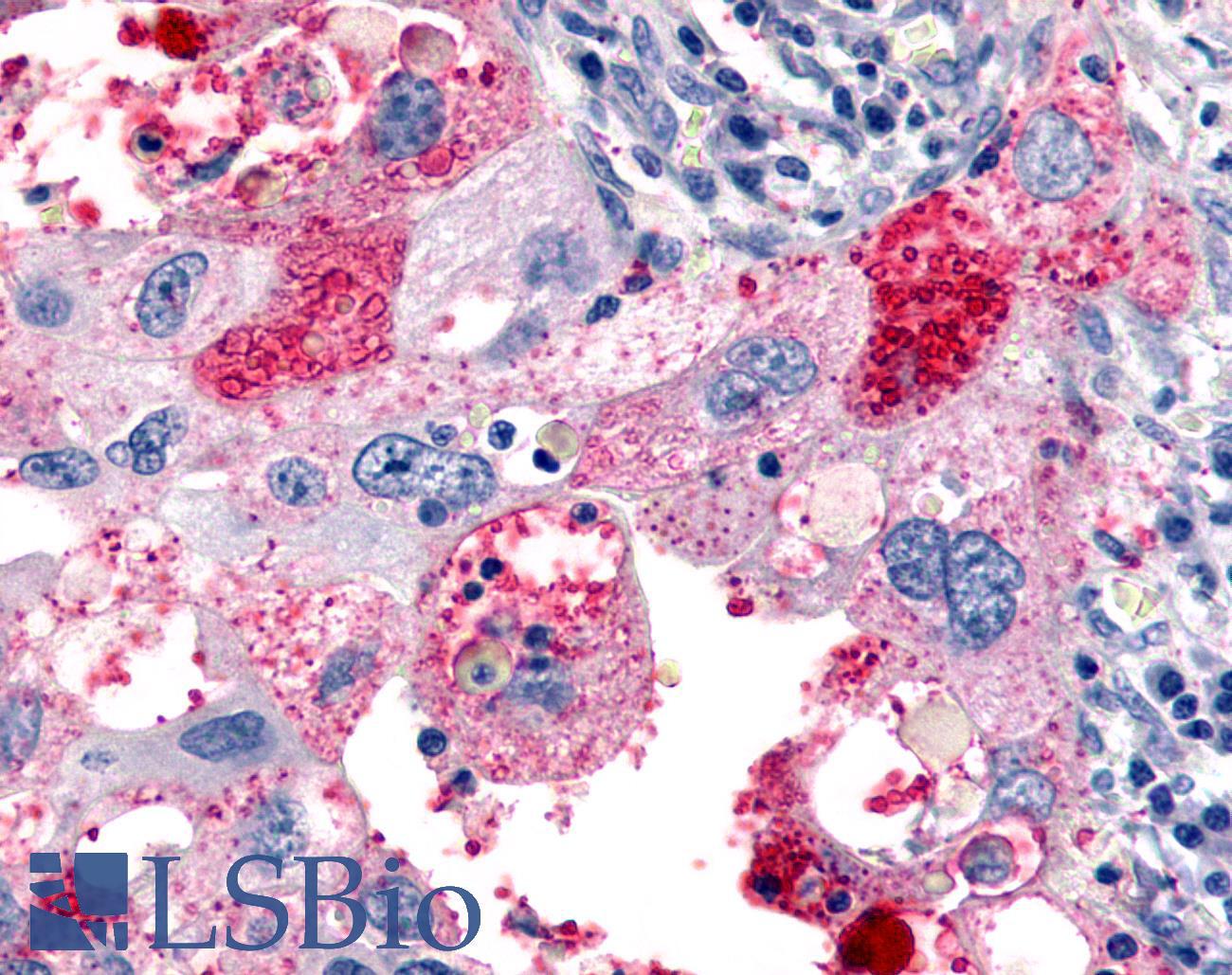 ADGRL4 / ELTD1 Antibody - Lung, Non Small-Cell Carcinoma