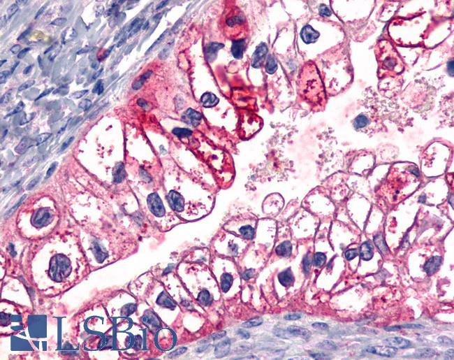 ADGRL4 / ELTD1 Antibody - Ovary, carcinoma