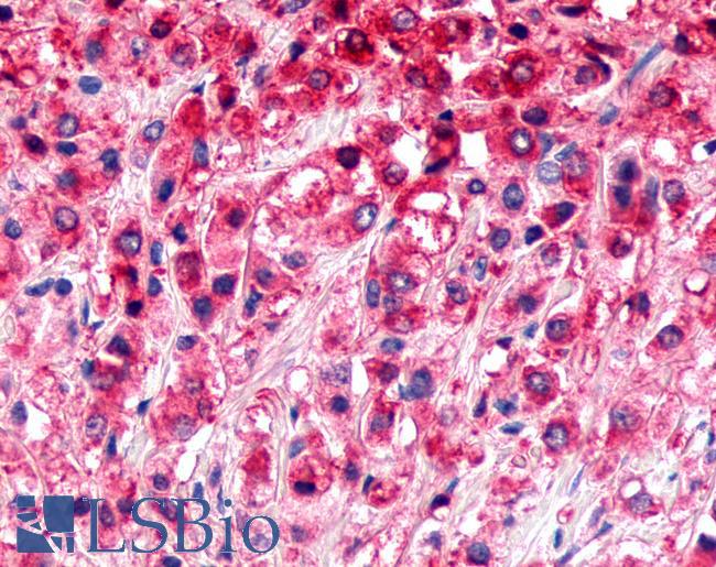 ADGRL4 / ELTD1 Antibody - Prostate, carcinoma