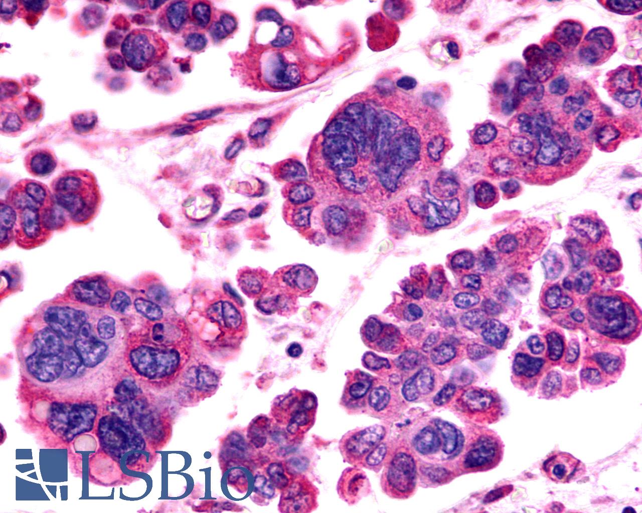ADGRV1 / GPR98 Antibody - Ovary, Carcinoma