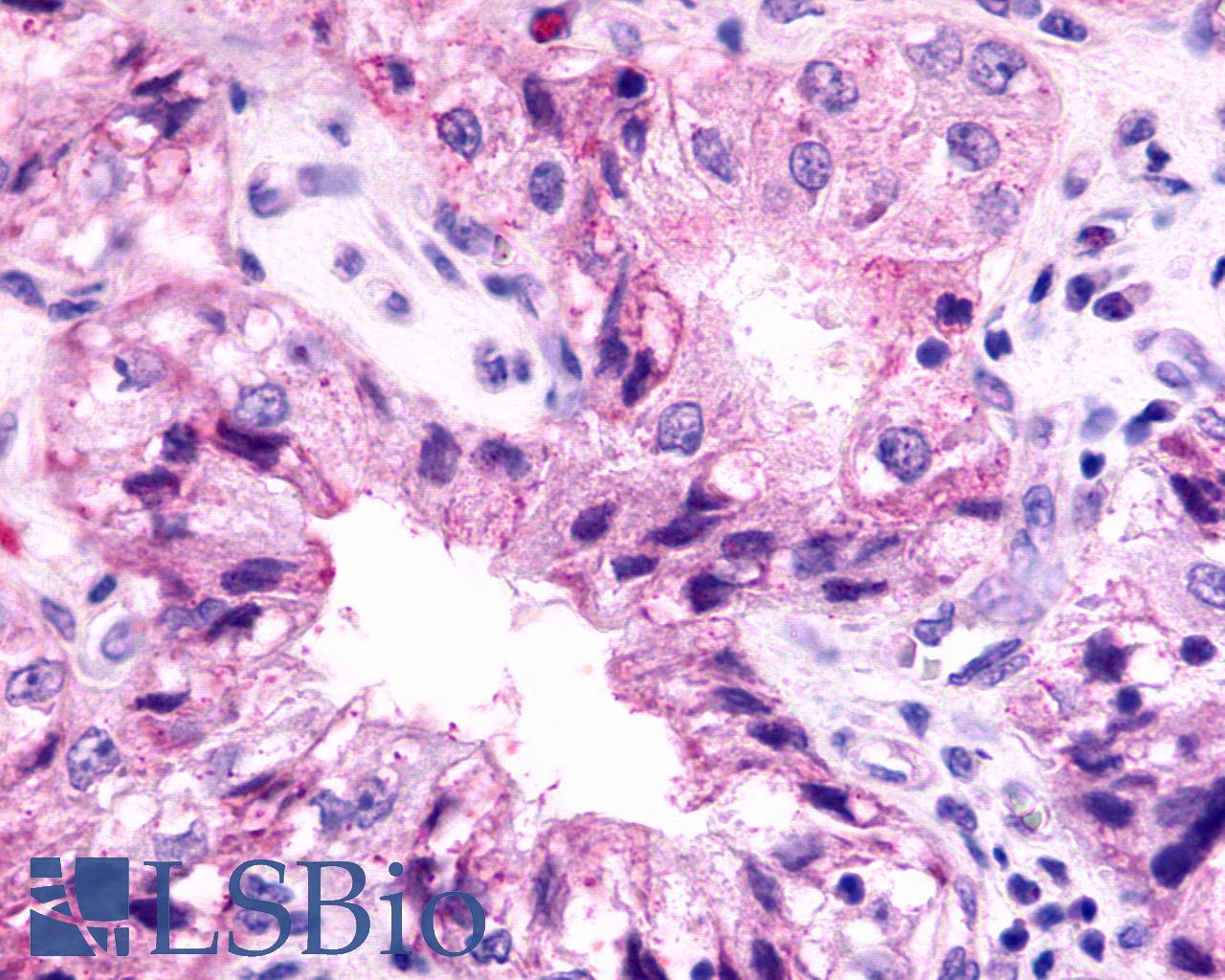 ADGRV1 / GPR98 Antibody - Lung, non small-cell carcinoma