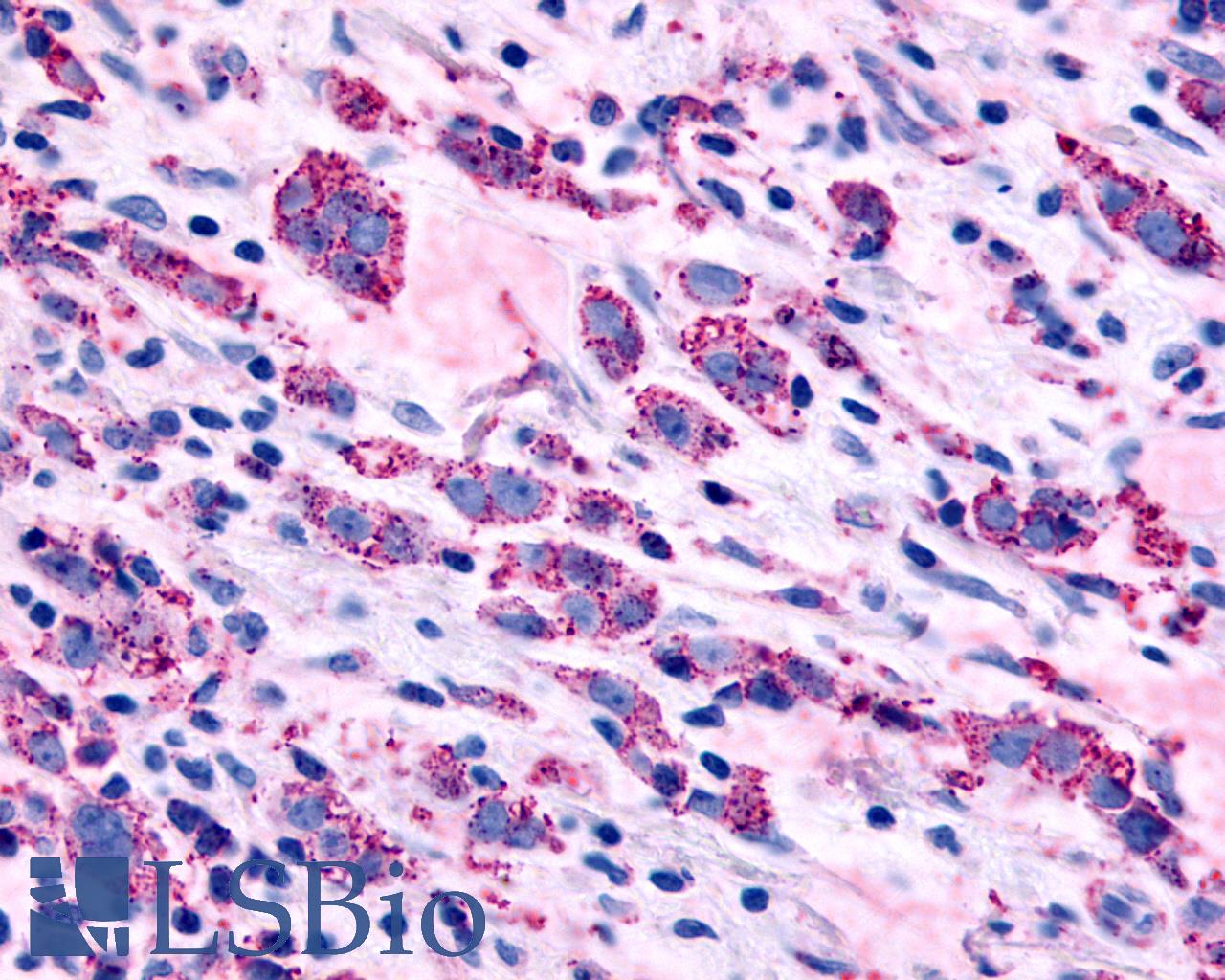 ADRA1B / Adrenoceptor alpha 1B Antibody - Anti-ADRA1B antibody IHC of human Breast, Carcinoma. Immunohistochemistry of formalin-fixed, paraffin-embedded tissue after heat-induced antigen retrieval.