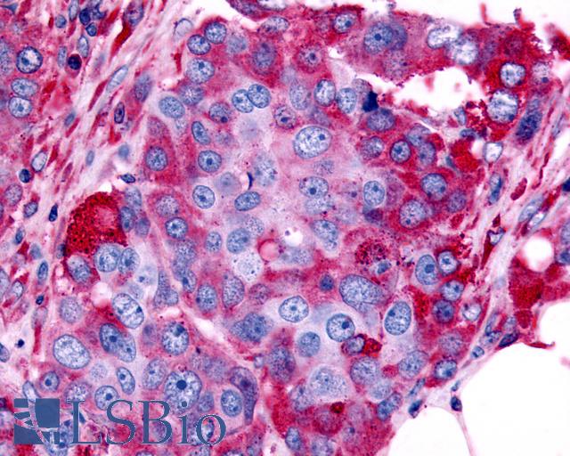 ADRA1B / Adrenoceptor alpha 1B Antibody - Anti-ADRA1B antibody IHC of human Ovary, Carcinoma. Immunohistochemistry of formalin-fixed, paraffin-embedded tissue after heat-induced antigen retrieval.