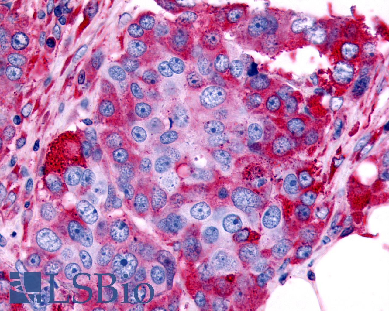 ADRA1B / Adrenoceptor alpha 1B Antibody - Anti-ADRA1B antibody IHC of human Ovary, Carcinoma. Immunohistochemistry of formalin-fixed, paraffin-embedded tissue after heat-induced antigen retrieval.