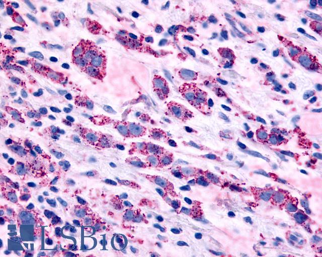 ADRA1B Antibody - Anti-ADRA1B antibody IHC of human Breast, Carcinoma. Immunohistochemistry of formalin-fixed, paraffin-embedded tissue after heat-induced antigen retrieval.