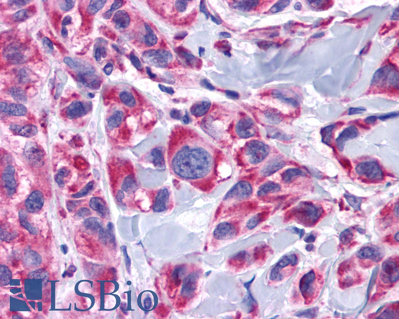 ADRA1D / Adrenoceptor alpha 1D Antibody - Anti-ADRA1D antibody IHC of human Skin, Melanoma. Immunohistochemistry of formalin-fixed, paraffin-embedded tissue after heat-induced antigen retrieval.