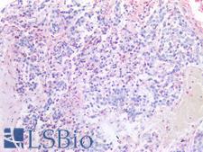 Alpha-Fetoprotein Antibody - Human Liver, Hepatocellular Carcinoma: Formalin-Fixed, Paraffin-Embedded (FFPE)
