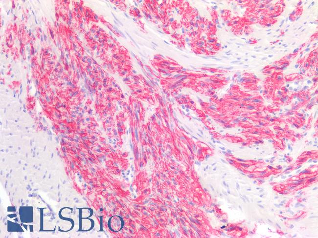 ANO1 / DOG1 / TMEM16A Antibody - Human Gastrointestinal Stromal Tumor: Formalin-Fixed, Paraffin-Embedded (FFPE)