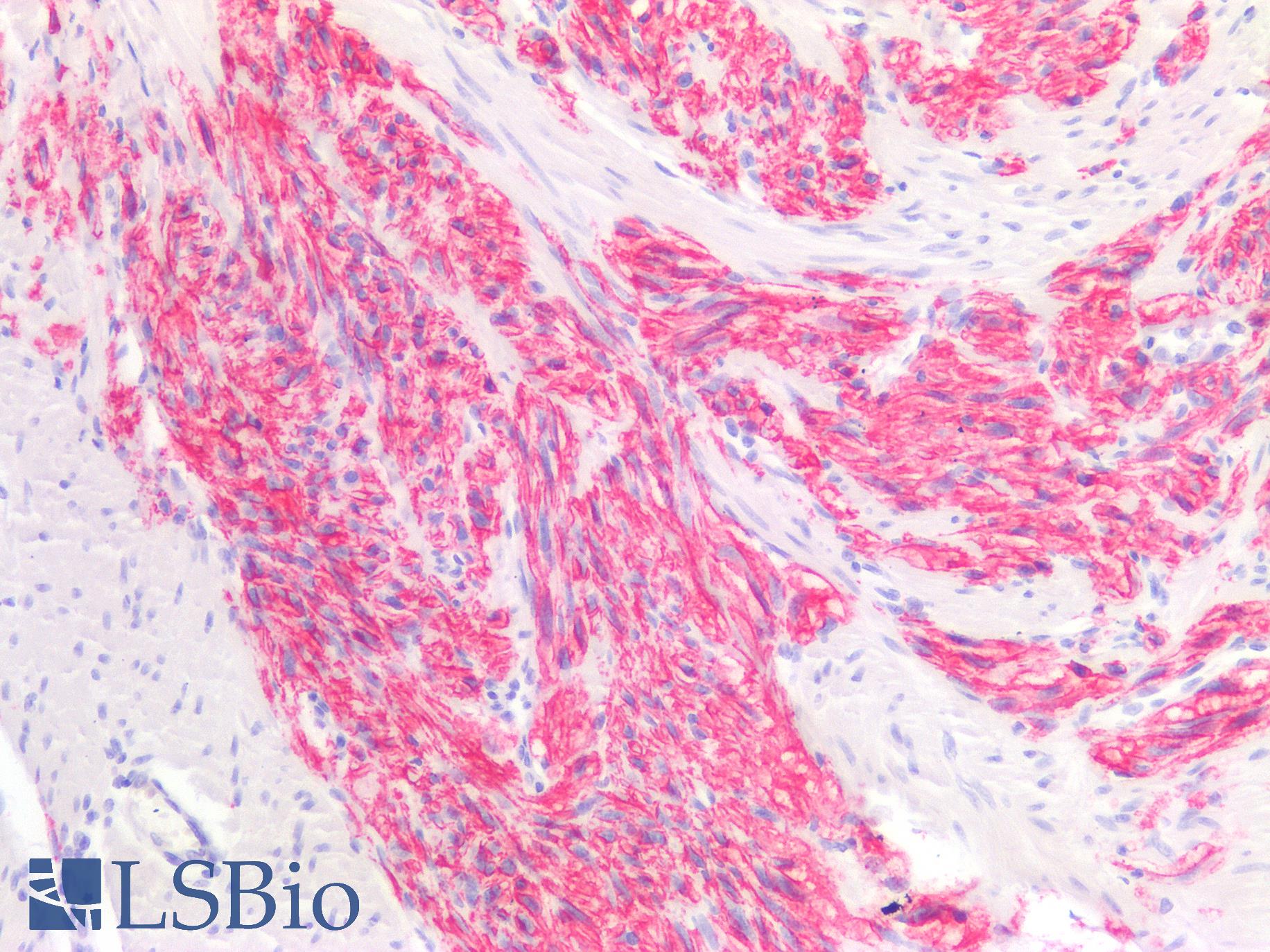 ANO1 / DOG1 / TMEM16A Antibody - Human Gastrointestinal Stromal Tumor: Formalin-Fixed, Paraffin-Embedded (FFPE)