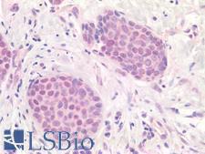 APOBEC3B Antibody - Human Breast Carcinoma: Formalin-Fixed, Paraffin-Embedded (FFPE)