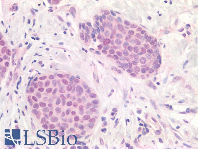 APOBEC3B Antibody - Human Breast Carcinoma: Formalin-Fixed, Paraffin-Embedded (FFPE)