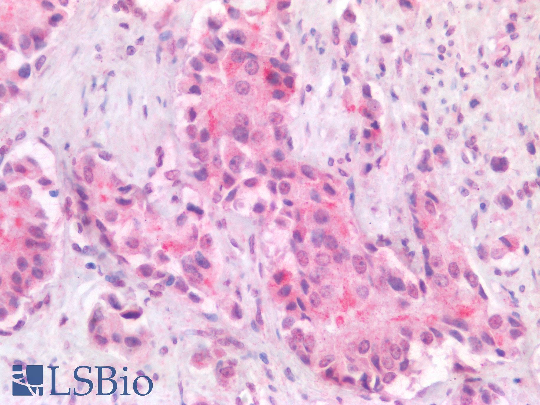 APOBEC3B Antibody - Human Prostate Carcinoma: Formalin-Fixed, Paraffin-Embedded (FFPE)