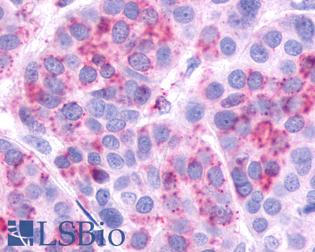 AVPR2 / V2R Antibody - Ovary, carcinoma