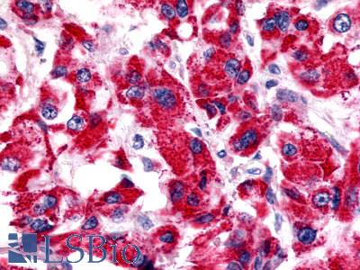 BOB / GPR15 Antibody - Breast, adenocarcinoma