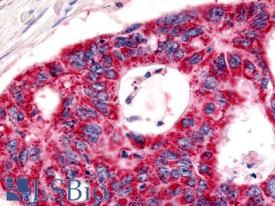BOB / GPR15 Antibody - Colon, adenocarcinoma