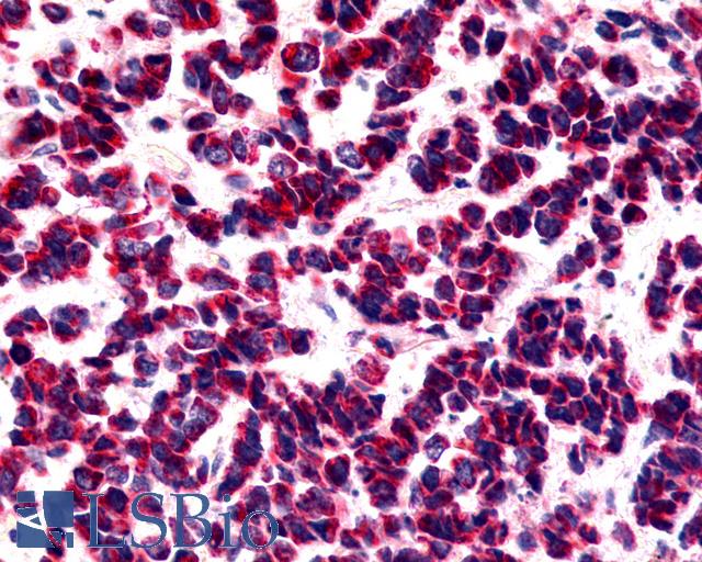 BOB / GPR15 Antibody - Anti-BOB / GPR15 antibody IHC of human Lung, Small Cell Carcinoma. Immunohistochemistry of formalin-fixed, paraffin-embedded tissue after heat-induced antigen retrieval.