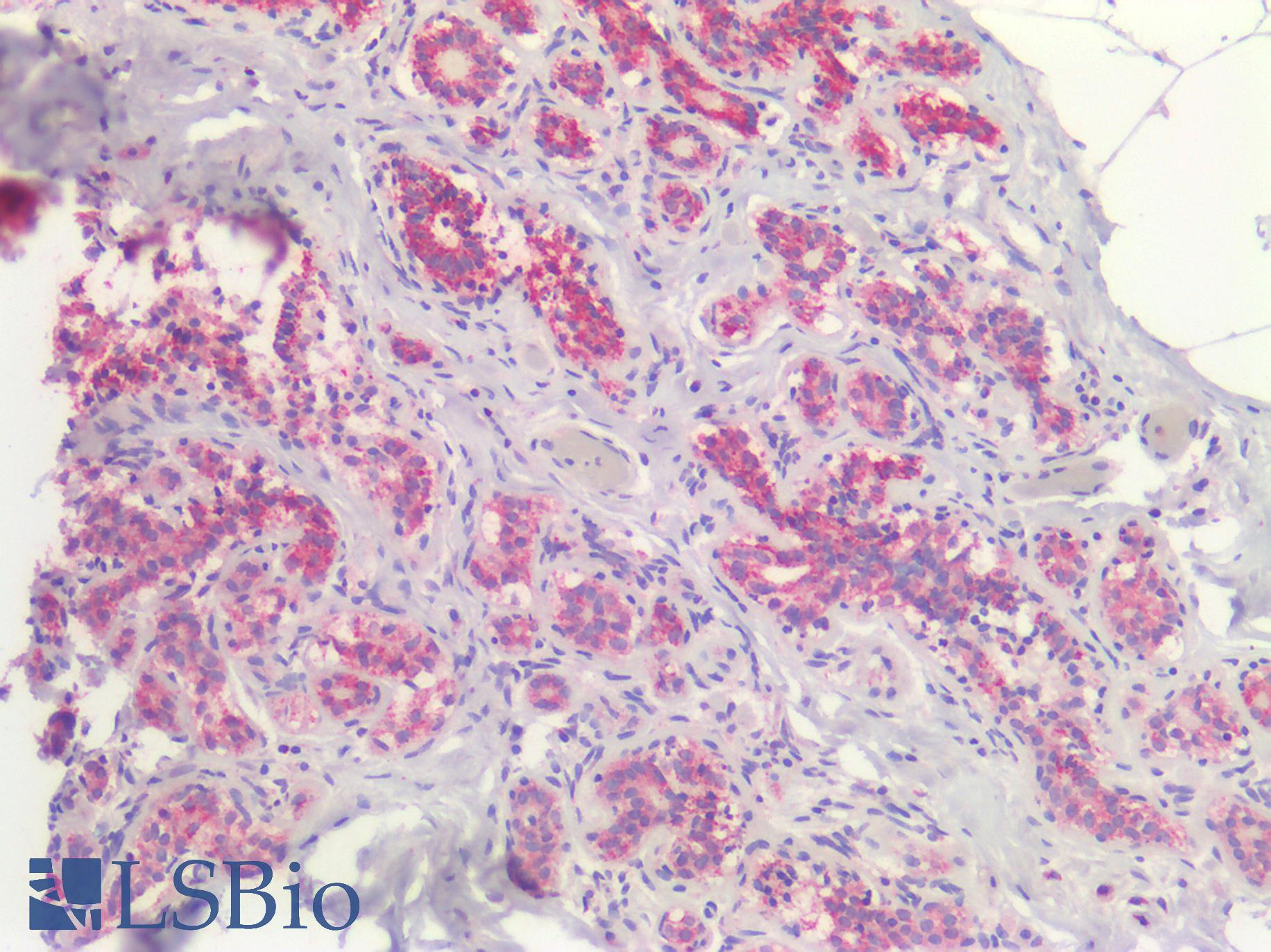 BRAF / B-Raf Antibody - Human Breast, Carcinoma: Formalin-Fixed, Paraffin-Embedded (FFPE)